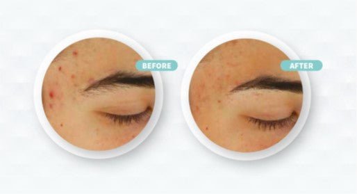 Before and after acne skincare treatment